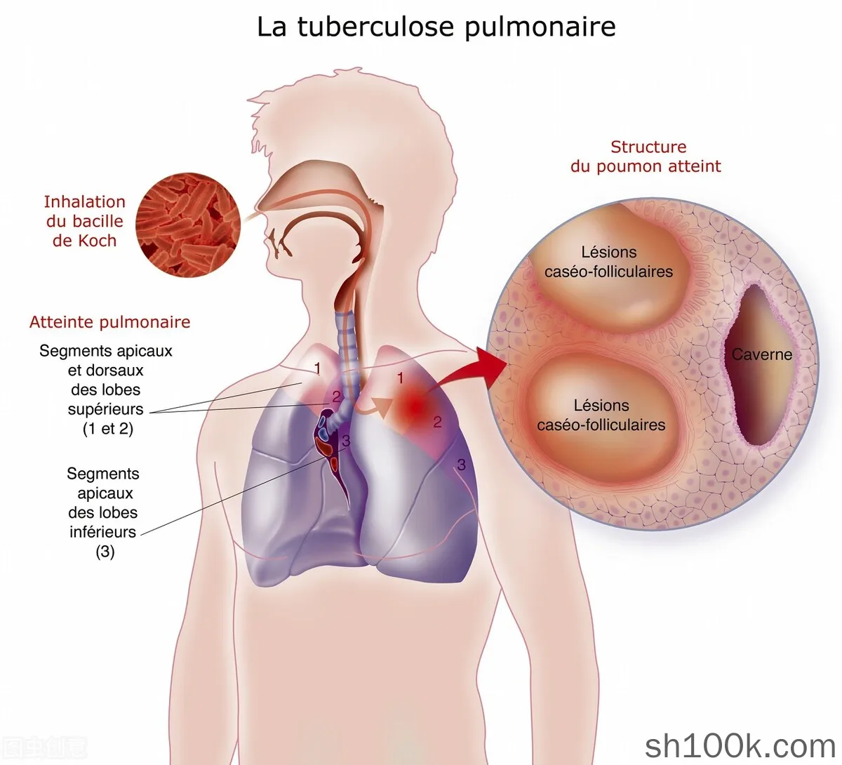 初期肺結核有哪些症狀 肺結核如何傳染